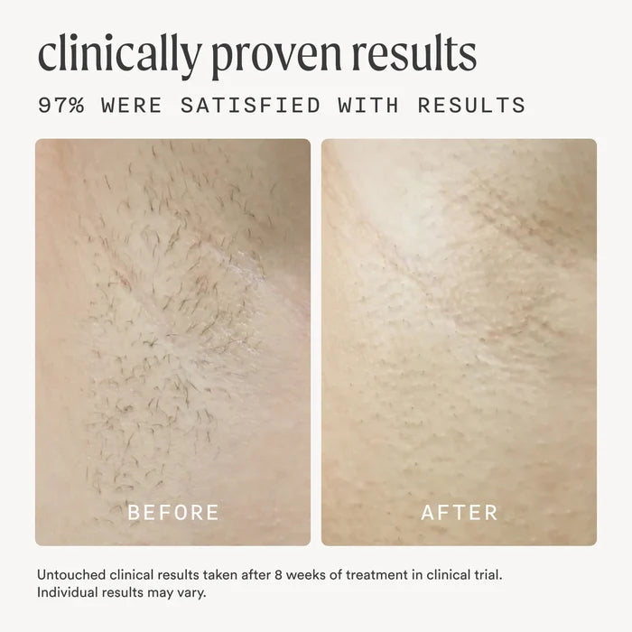 Clinically proven IPL hair removal results showing 97% customer satisfaction with before and after comparison after 8 weeks of Nood treatment